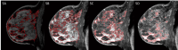 Quantification of breast parenchyma enhancement (BPE)